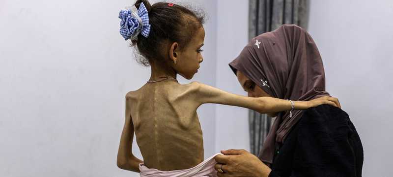 The Dissection of Starvation in Gaza